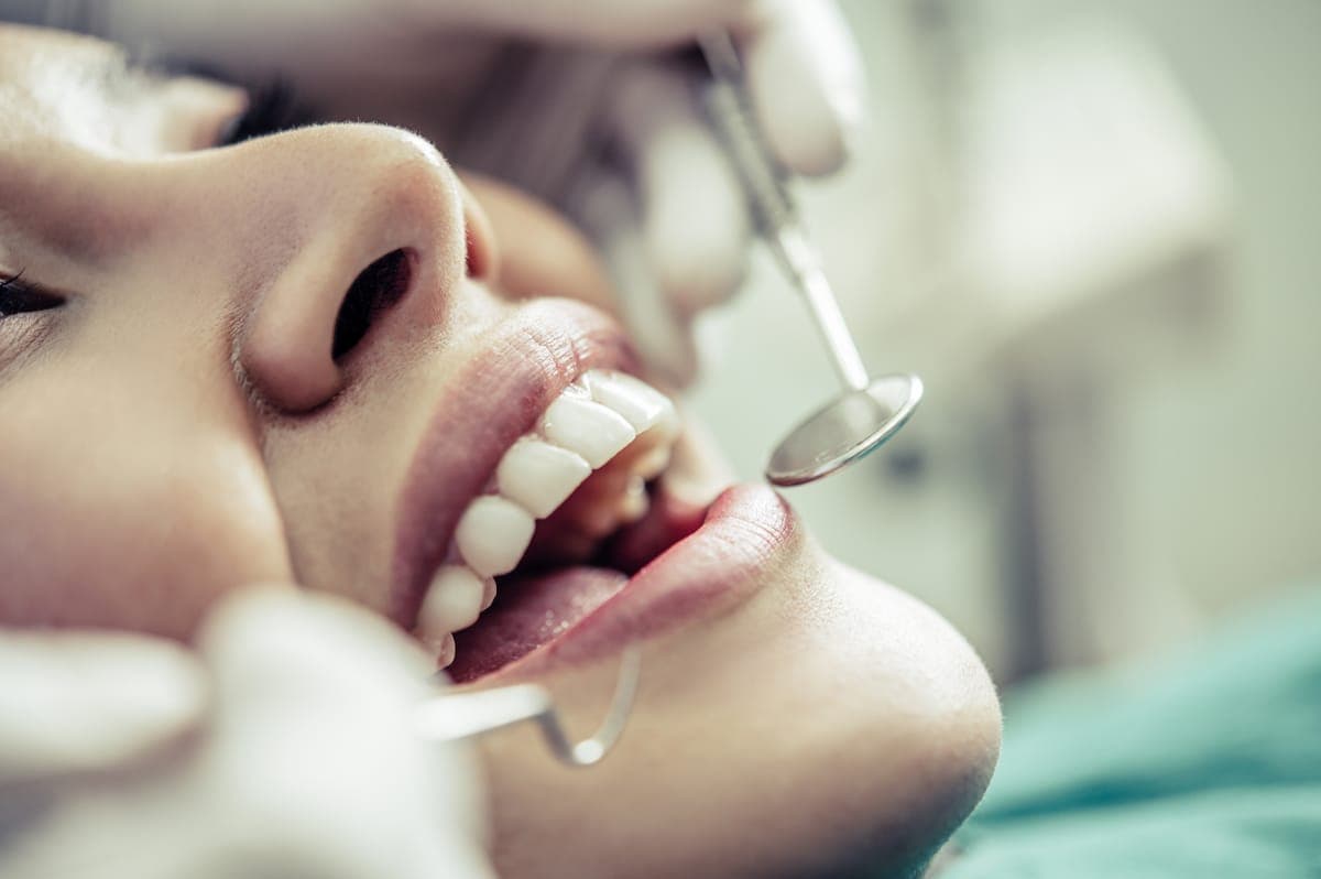 Mitos e verdades sobre clareamento dental